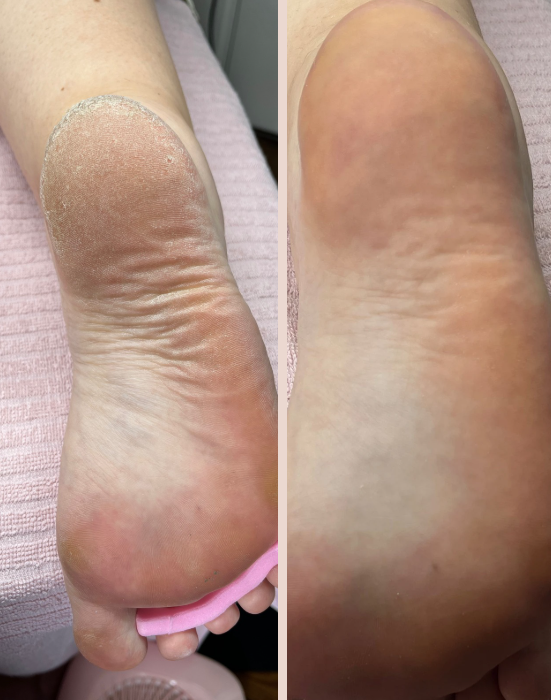 Soins des pieds avant et après, institut de beauté à Alfortville. Résultats remarquables pour le bien-être de vos pieds.